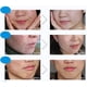 thumbnail image 2 of Crema De Eliminación De Cicatrices De Acné Facial 4 En 1 100 G+30 G+30 Ml, 2 of 9