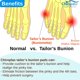 thumbnail image 5 of Corrector de Juanetes Chiroplax con Gel Protector para los Dedos, 5 of 7