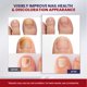 thumbnail image 5 of Parches para Hongos en Uñas de los Pies Treatonic Renovación Nocturna 32 Piezas, 5 of 9