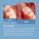 thumbnail image 5 of Kit De Reparación Dental M3 Dental Grade Con Funda De Viaje, 5 of 9