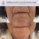 thumbnail image 5 of Dispositivo de estiramiento facial UpLift 5 pulsante con cambio de edad en 5 minutos, 5 of 8