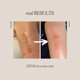 thumbnail image 4 of Crema para cicatrices ESTAS Beauty – Kit de 3 productos (150 ml), 4 of 6