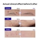 thumbnail image 3 of Tratamiento para árboles de té Spot Patch Mediheal Derma Clear, 132 parches, 3 of 8