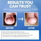 thumbnail image 5 of Kit de tratamiento para uñas encarnadas CurveCorrect con 10 aparatos de ortodoncia transparentes, 5 of 8
