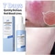 thumbnail image 1 of LAIKOU 7X CERAMIDE Facial Serum Rosacea Red Blood Vein Treatment Improve Sensitive Repair Moisturizing Serum Korean Cosmetics, 1 of 3