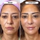 thumbnail image 3 of Sistema de microinfusión Glov Beauty, sello facial dorado de 0,25 mm, 3 of 9