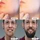 thumbnail image 5 of Rodillo de microagujas Derma Roller 540 de titanio para rostro y cuerpo, 5 of 6