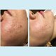 thumbnail image 5 of Gel Peeling Perfect Image 30 % Ácido Salicílico 30 ml, 5 of 8