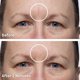 thumbnail image 4 of Aplicador de relleno de cicatrices Dermaflage, 4 of 7
