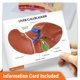 thumbnail image 5 of Modelo Anatómico de Hígado GPI Anatomicals 20 × 14 × 14 cm con Cálculos Biliares, 5 of 5