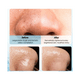 thumbnail image 3 of Extractor Removedor Puntos Negros Poros Multifuncional, 3 of 4