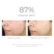 thumbnail image 5 of Limpiador facial Derma E Acne, limpiador de poros profundos, 180 ml, 5 of 8