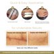 thumbnail image 4 of Parches de silicona para cicatrices EMBRACE 16 cm, suministro de 30 días, talla extra grande, 4 of 6