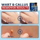 thumbnail image 4 of Eliminador de verrugas MEOLY Freeze Off de acción rápida 30 ml con ácido salicílico, 4 of 8