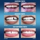 thumbnail image 3 of Diente falso temporal Imako Tooth, plástico tintado, paquete de 2, 3 of 5
