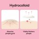 thumbnail image 5 of Parche de Acné HANHOO 108 uds – Reduce espinillas y puntos blancos, 5 of 8