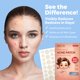 thumbnail image 5 of MEDca Universal Acne Patches | 2 Sizes | Hydrocolloid Bandages | 360 Pcs, 5 of 9
