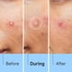 thumbnail image 4 of Hidrocoloide facial Pimple Patches Glowpatch 504 unidades, 4 of 8