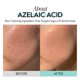 thumbnail image 4 of Crema hidratante RE:CIPE Ácido Azelaico 10% 50 ml, 4 of 8
