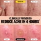 thumbnail image 4 of Pimple Patches PEACE OUT Acne Dúo para día y noche, 20 puntos, 4 of 9