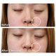 thumbnail image 5 of Aplicador de relleno de cicatrices Dermaflage, 5 of 7