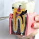 thumbnail image 5 of Dientes de caries dental modelo Ceonam 6 veces agrandados, 5 of 6