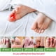 thumbnail image 3 of Protector de Dedos Niupiour 14 unidades de Gel Transpirable, 3 of 7