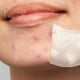 thumbnail image 3 of Set 2 Parches Para Acne Microagujas Imperfecciones Piel Lau, 3 of 3