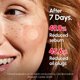 thumbnail image 5 of Parche para espinillas Dermafirm CICA AC Spot Patch 99EA, 5 of 8