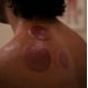 thumbnail image 4 of Set De Terapia Con Ventosas Liberador Miofascial Con 18 Ventosas, 4 of 7