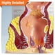 thumbnail image 2 of Modelo de Recto Humano GPI Anatomicals con Patologías, 2 of 6