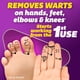 thumbnail image 2 of Removedor de verrugas por crioterapia Freezer Silka Pointts con 12 puntas, 2 of 9