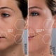 thumbnail image 2 of Kit de reemplazo de dermaplaning Michael Todd Sonicsmooth Pro+, 2 of 7