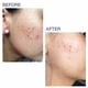 thumbnail image 4 of Barra De Tratamiento De Cicatrices Pro sil Spf 15 4 25 G, 4 of 9