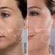 thumbnail image 5 of Sistema de dermaplanamiento Michael Todd Beauty Sonicsmooth Pro+, 5 of 8