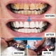 thumbnail image 4 of 3 herramientas dentales, palillo de acero inoxidable 304 100 % quirúrgico, kit profesional de limpieza dental para uso doméstico, removedor de placa de sarro, raspador dental, con estuche de viaje., 4 of 7