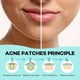 thumbnail image 2 of Hydrocolloid Acne Patches: Daily Skin Care for Zits & Blemishes - Mild & Non-Irritating!, 2 of 4