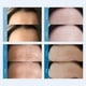 thumbnail image 4 of Parche antiarrugas para frente Dersie (3 unidades), 4 of 7