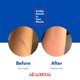 thumbnail image 4 of Láminas de silicona para cicatrices, todas buenas, 4 x 7 pulgadas [5 hojas] de grado médico, 4 of 8