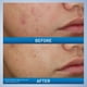 thumbnail image 5 of Cerave Crema limpiadora espumosa para el acné | Limpiador suave para rostro y cuerpo con peróxido de benzoilo y ácido hialurónico 10%, 150ml, 5 of 11