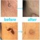 thumbnail image 3 of 30pcs/box Mole Removal Shrink Ring Non-Toxic Mole Removal Rubber Bands Kit Wart Treat Tool for Men Women Beauty Health Care, 3 of 3