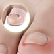 thumbnail image 5 of Herramienta para corregir uñas encarnadas, pinza elástica para enderezar uñas, correctores de silicona para uñas de los pies, 5 of 8