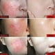 thumbnail image 2 of Instant Repair Facial Redness Cream Soothing Red Blood Rosacea Treatment Improve Sensitive Skin Moisturizer Skin Care Cosmetics, 2 of 3
