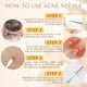 thumbnail image 2 of Kit De 16 Herramientas Para Eliminar Puntos Negros Y Extraer Granos, 2 of 6