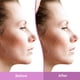thumbnail image 5 of Gel Differin para tratamiento facial de manchas y cicatrices de acné, 30 ml, 5 of 9