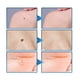 thumbnail image 3 of Removedor Crema De Verrugas Tratamiento Indoloro, 3 of 8