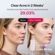 thumbnail image 3 of Mascarilla facial de terapia de luz LED Ulike ReGlow para mujer, 3 of 8
