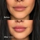 thumbnail image 2 of Voluminizador de labios Nelux 3 ml (Ácido Hialurónico), 2 of 7