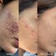 thumbnail image 3 of Tratamiento de acné Orbe It! 30 ml Ácido Salicílico 2 pasos, 3 of 9