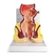 thumbnail image 1 of Modelo de Recto Humano GPI Anatomicals con Patologías, 1 of 6